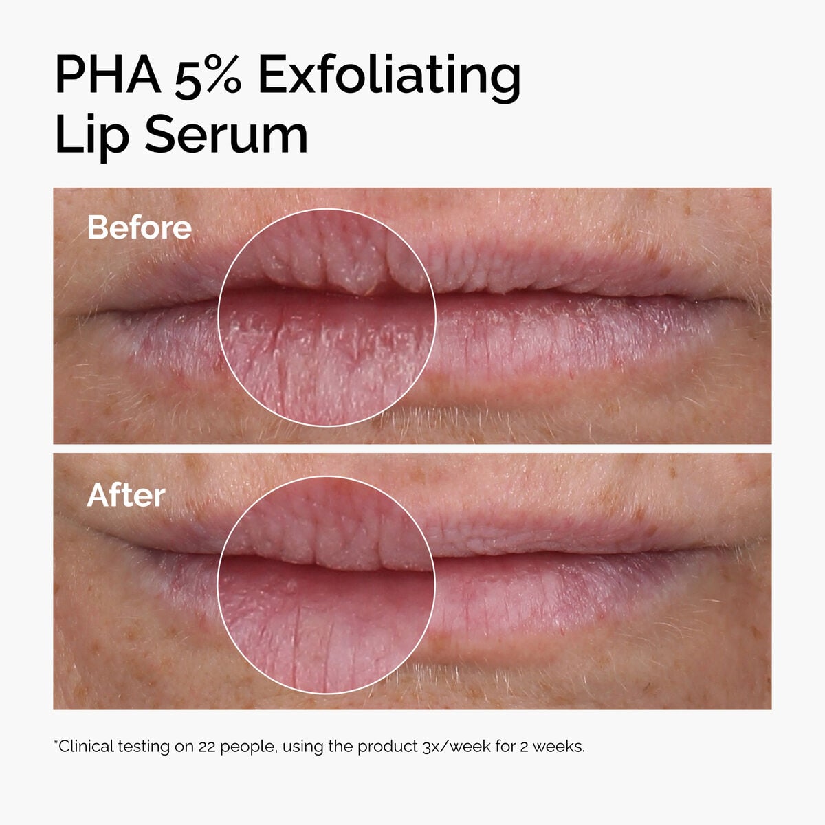 pha-5-exfoliating-lip-serum-x2 ord-pha-5pct-lip-exfoliating-serum-before-after.jpg