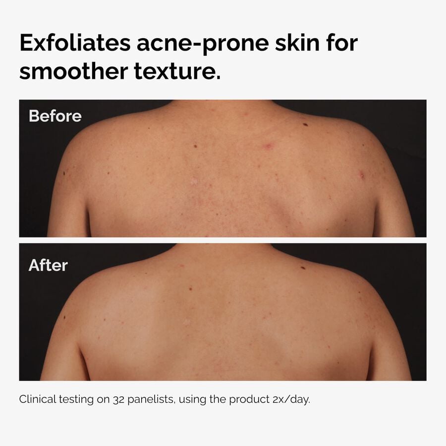 the-body-care-collection-e1 ord-salicylic-acid-body-serum-before-after-graphic-NA.jpg